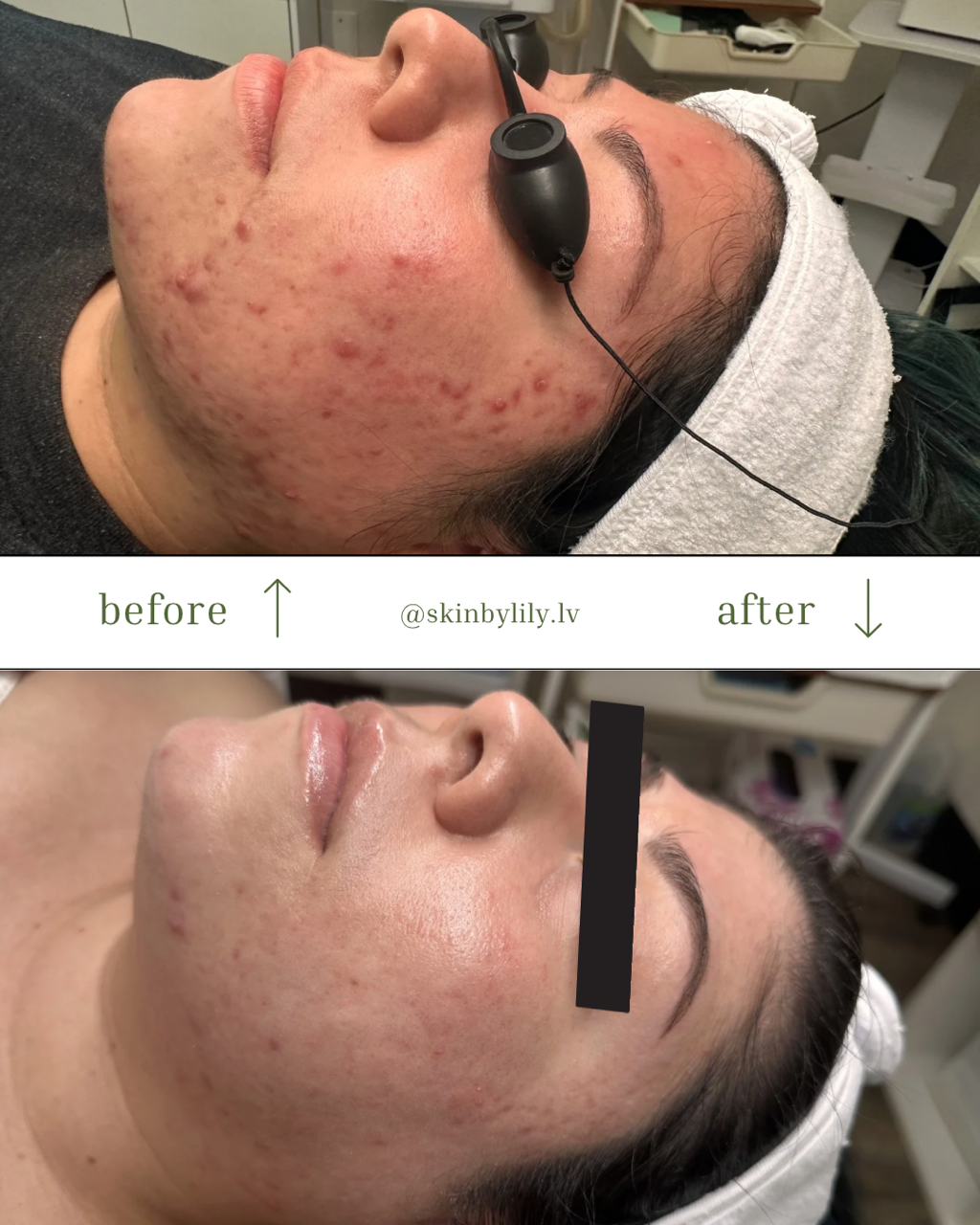 Acne Transformation