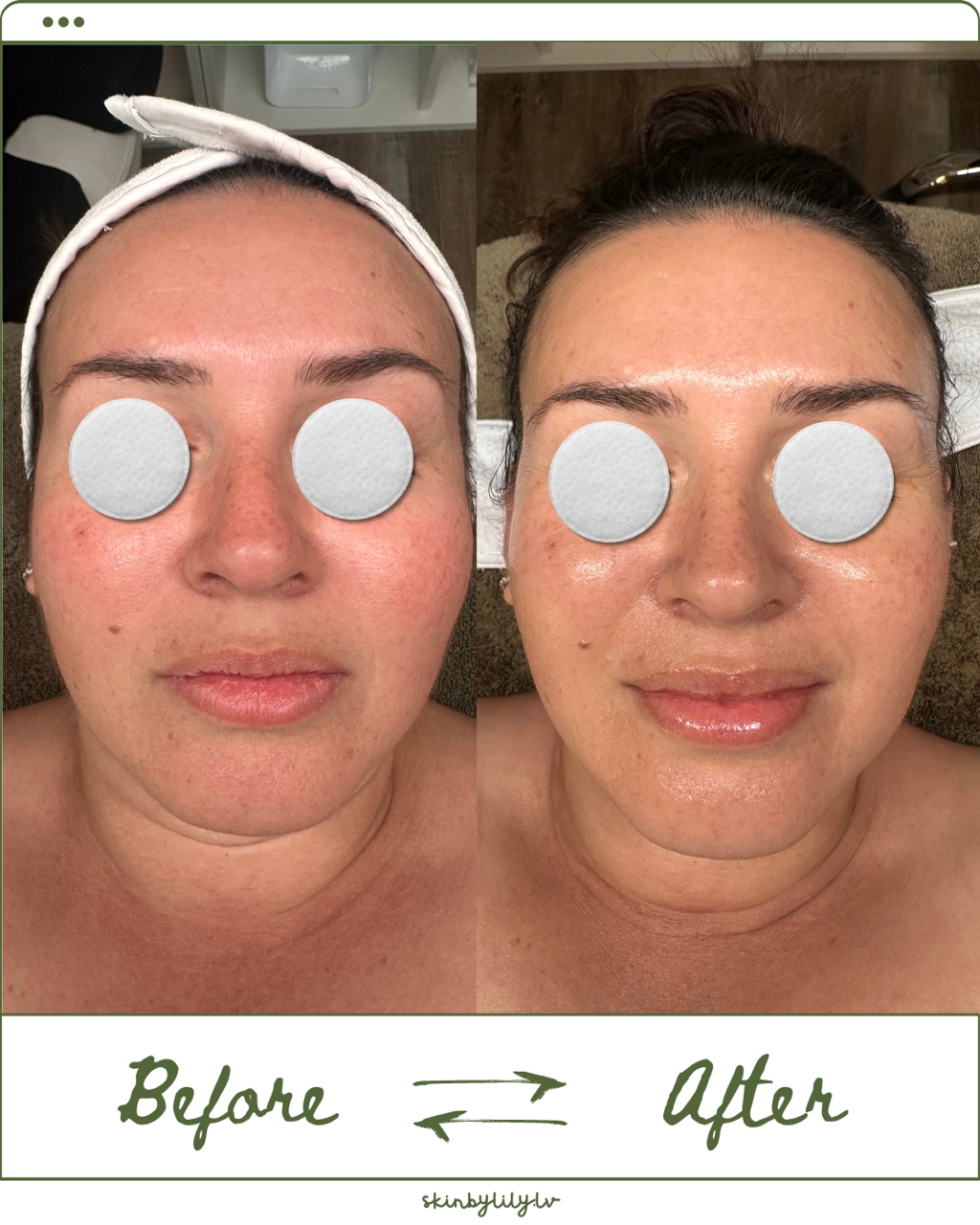 Redness Transformation